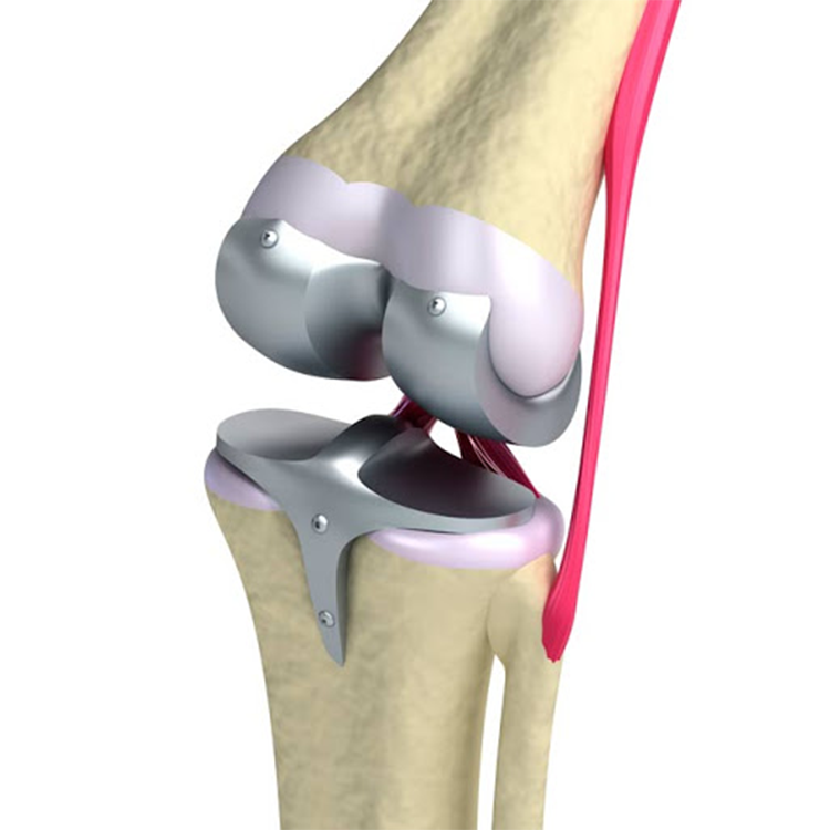 Implante de Rodilla