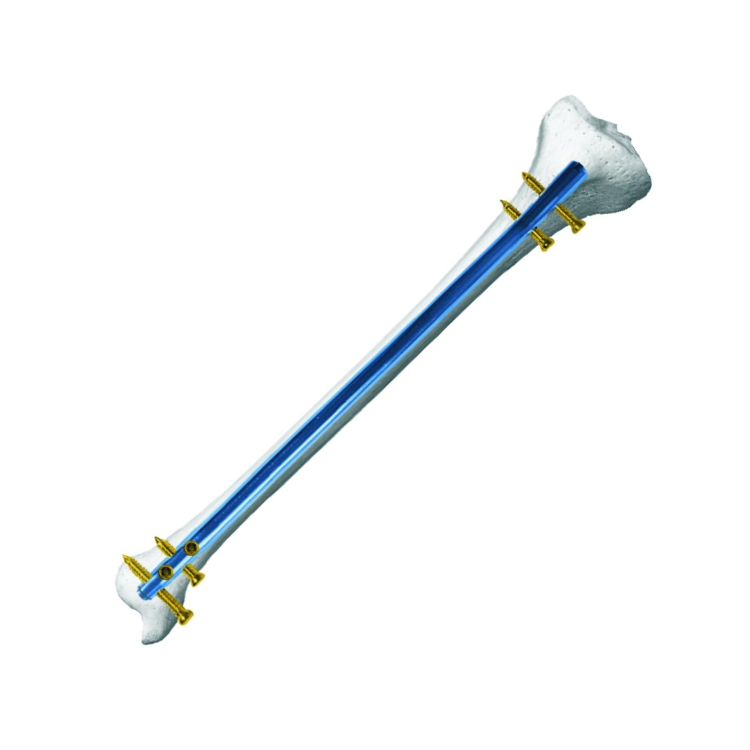 Clavo Endomedular de Tibia