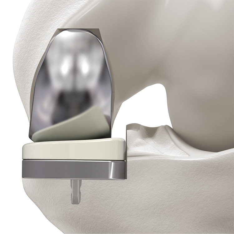 Implante de Rodilla Unicompartimental