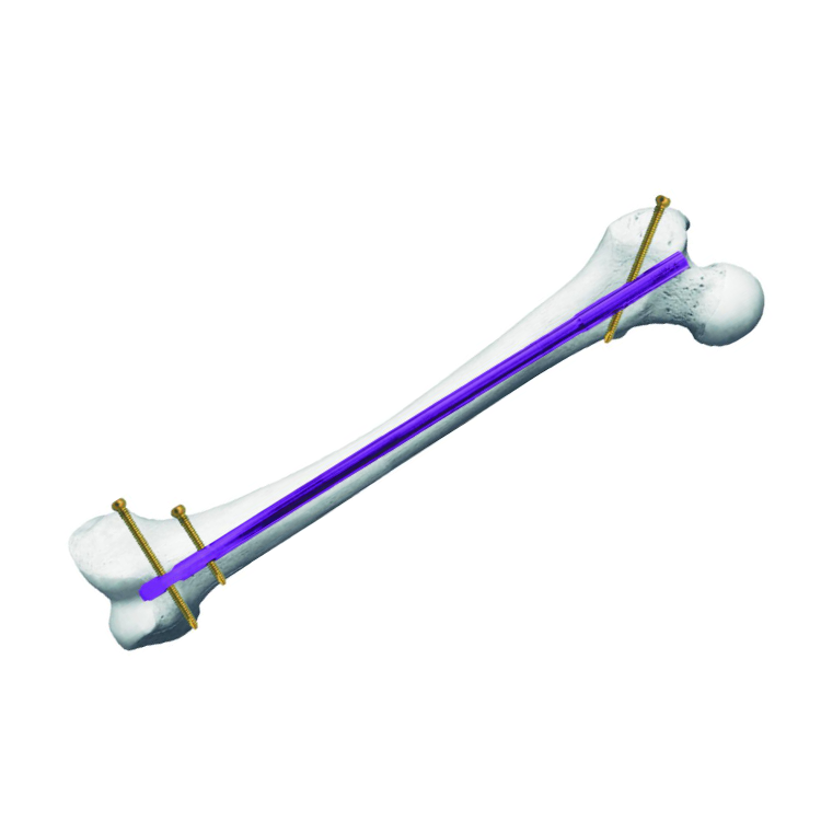 Clavo Endomedular de Femur