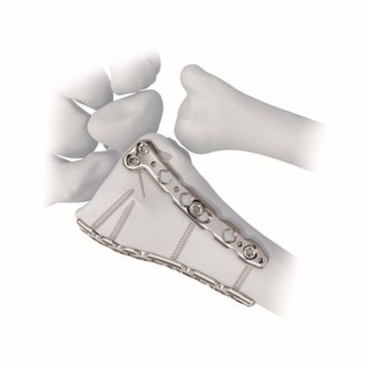 Placas para Extremidades (Acero / Titanio)