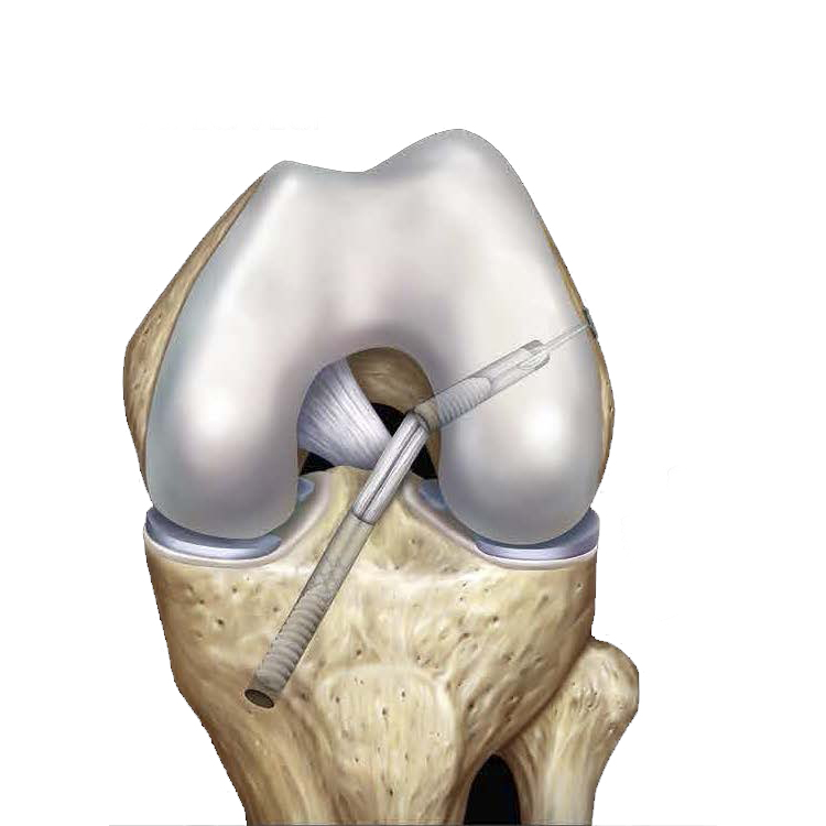 Tornillos para Ligamento Cruzado